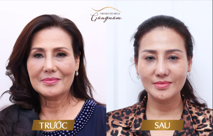 chi-my-linh-cang-chi