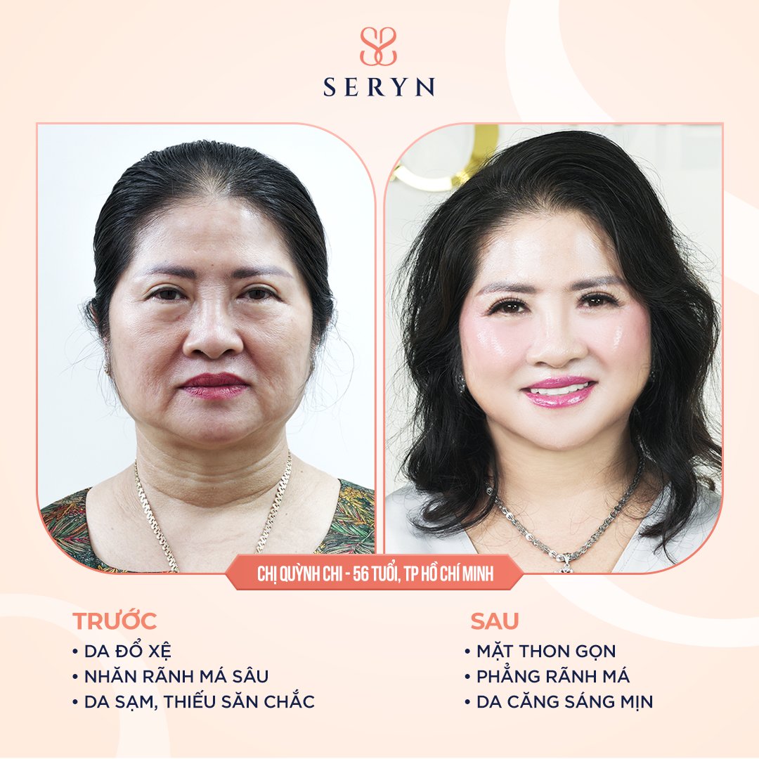 Hiệu quả thực tế sau của khách hàng sau liệu trình trẻ hóa tại phòng khám SERYN
