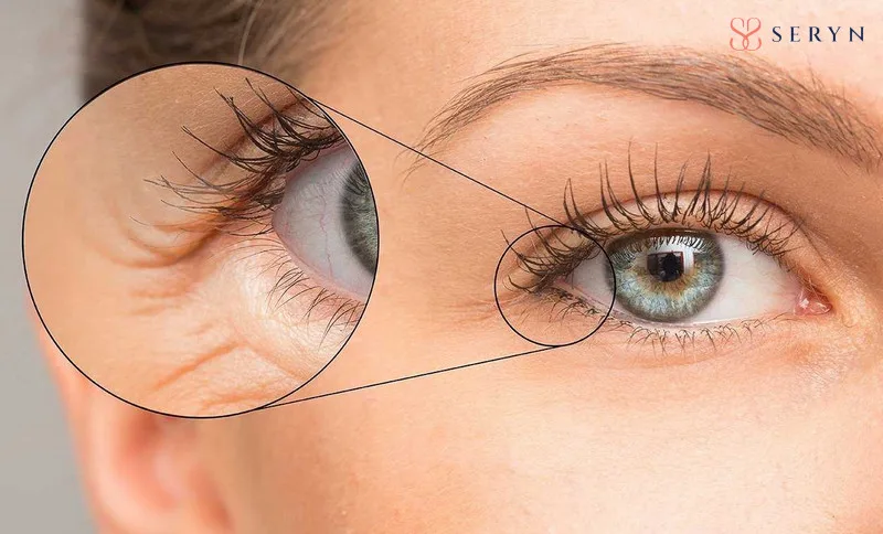 Nếp nhăn ở mắt xuất hiện sớm ngay cả khi bạn còn trẻ 