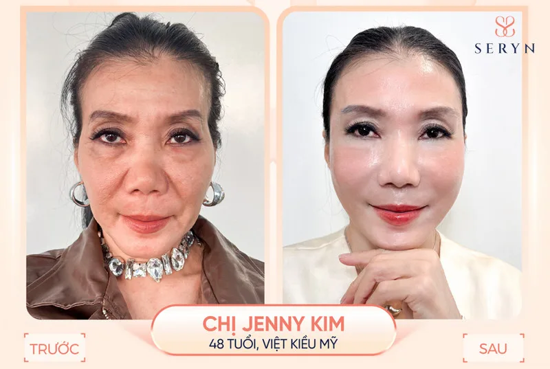 Nét phúc tướng sau khi chỉnh sửa trên trán có 3 nếp nhăn bằng SERA CORE