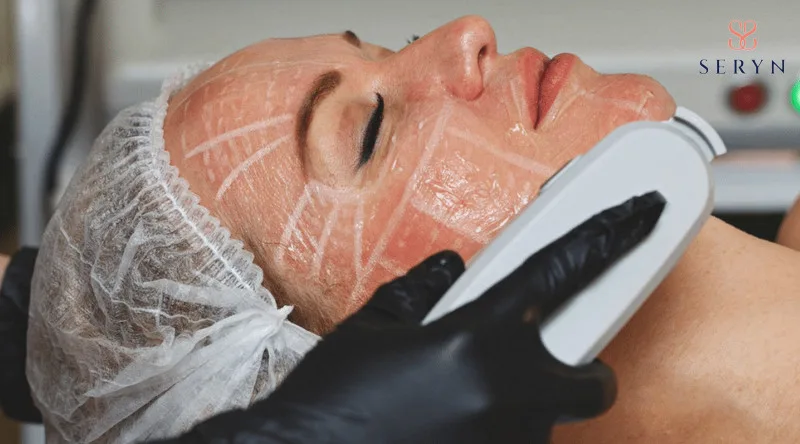 Xóa nhăn bằng HIFU công nghệ sử dụng sóng siêu âm hội tụ tác động vào cấu trúc da 