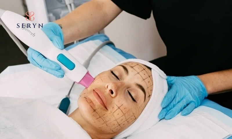 Vì sao nhiều người chọn căng da Thermage nhưng hiệu quả kém hơn kỳ vọng?