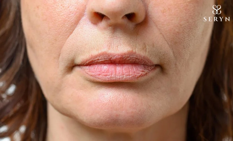 Khóe miệng sâu xuất hiện khi bạn bị sụt giảm mô cơ nâng đỡ do yếu tố lão hóa