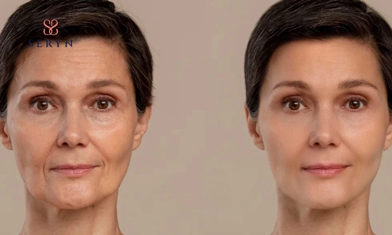 9+ bí quyết giúp bạn quyết định có nên căng da thẩm mỹ hay không!