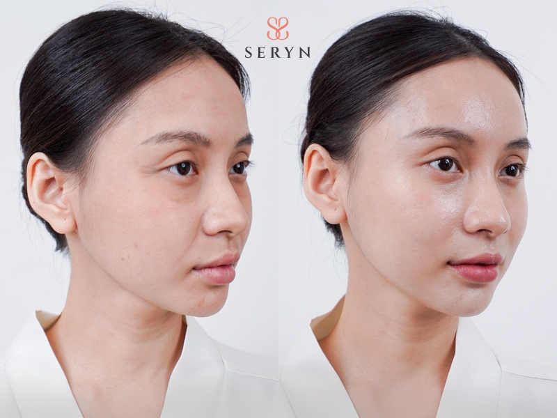 Nâng cơ mặt cho thấy hiệu quả rõ nhất sau 3–6 tháng Nâng cơ mặt cho thấy hiệu quả rõ nhất sau 3–6 tháng