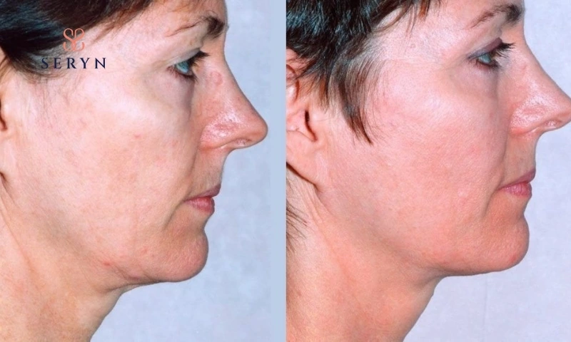 Xu hướng làm căng da mặt bền vững được ưa chuộng nhất năm 2026