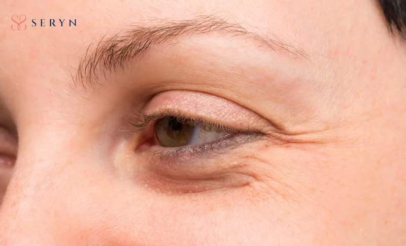 Mí mắt bị nhăn khiến gương mặt kém sắc và ảnh hưởng một phần tới góc nhìn "tài vận"