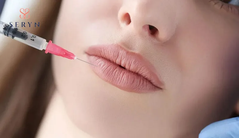 Cách trị môi nhăn bằng chất làm đầy HA - Filler 