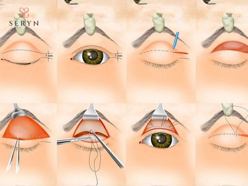 Kỹ thuật cắt cơ nâng mi giúp nâng mí mắt bị sụp hiệu quả