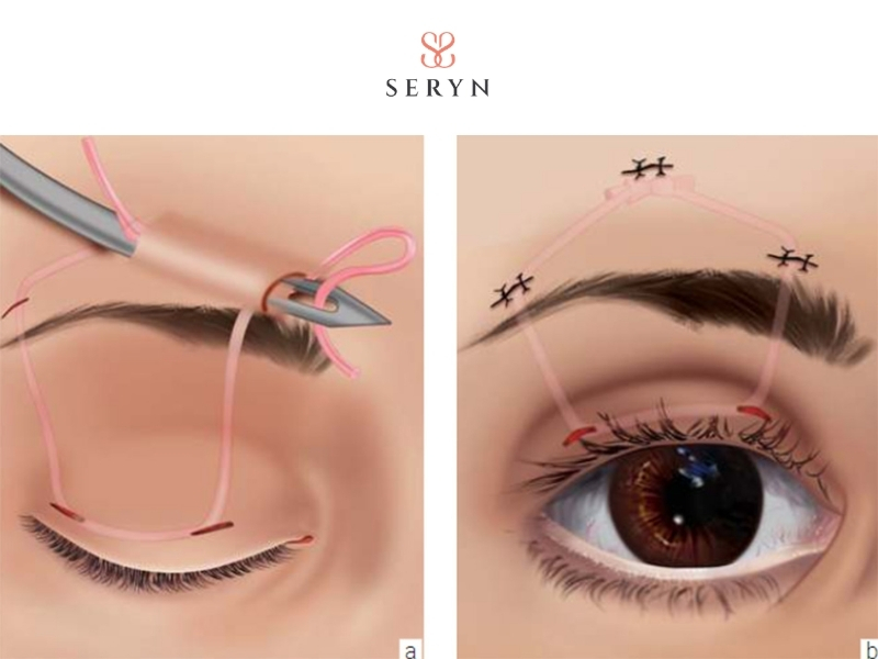 Treo mi vào cơ trán trong điều trị sụp mí nặng