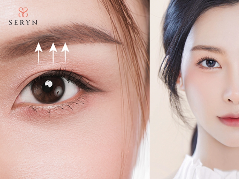 Nâng cơ mắt giúp cải thiện tình trạng mí mắt chảy xệ, mang lại đôi mắt trẻ trung và rõ nếp mí