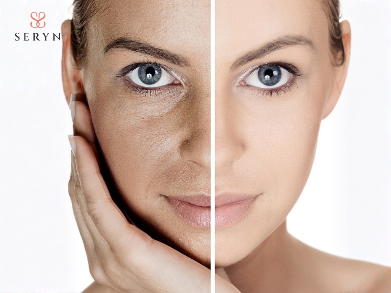 Nâng cơ mắt giúp cải thiện thẩm mỹ và làm gương mặt tươi trẻ hơn