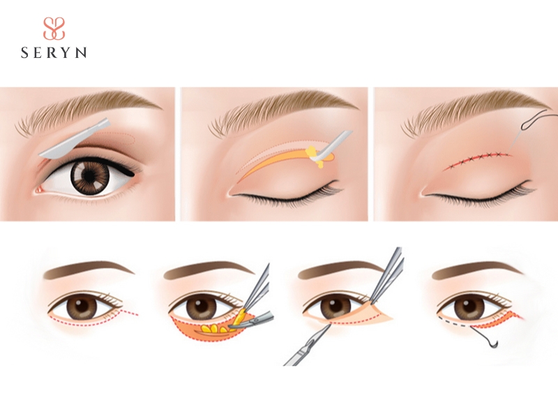 Phẫu thuật nâng cơ mí mắt giúp điều chỉnh cơ nâng mi và loại bỏ da thừa