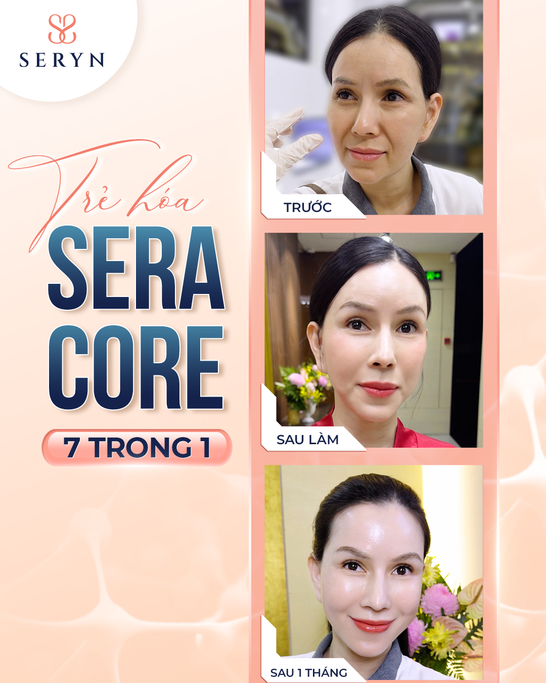 Công nghệ Sera Core giúp nâng cơ mắt, cải thiện mí mắt chảy xệ