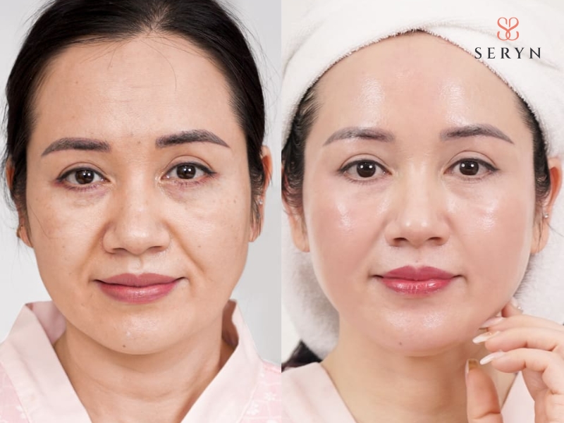 Thermage làm mờ nếp nhăn trán, vùng mắt và rãnh mũi má