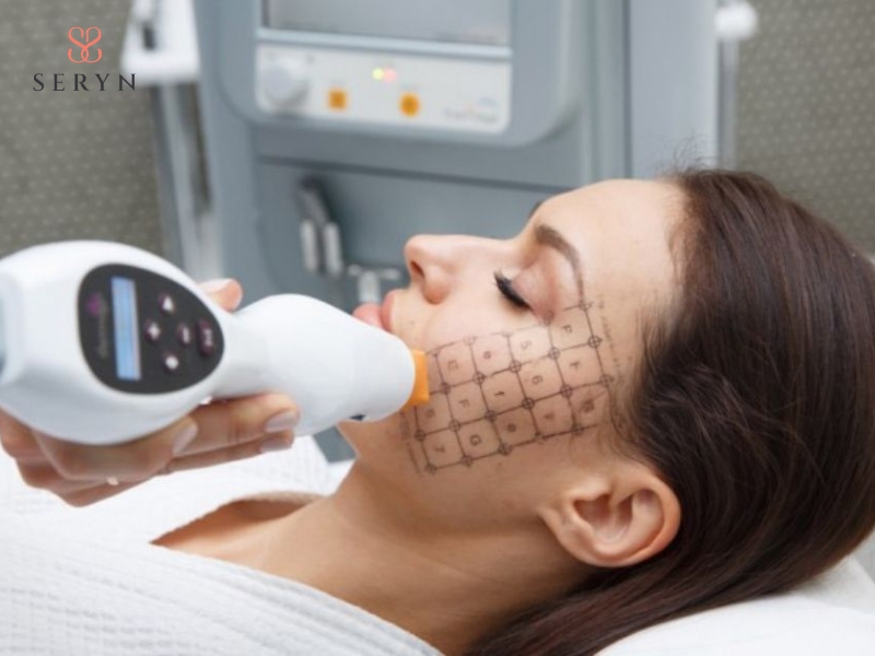 Đối tượng phù hợp nâng cơ mặt bằng Thermage theo độ tuổi và tình trạng da