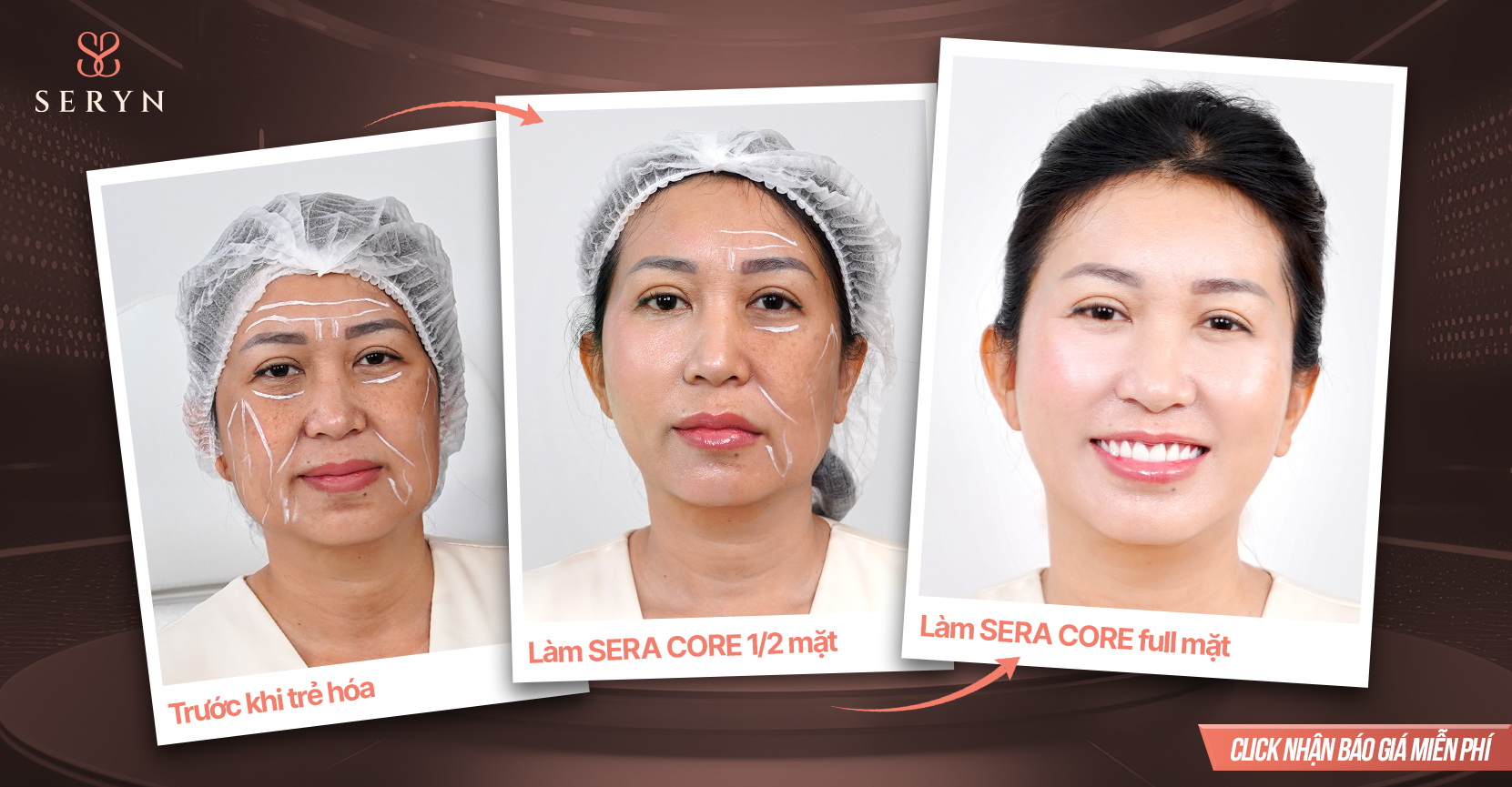 Công nghệ SERA CORE giúp nâng cơ, tái cấu trúc và trẻ hóa da toàn diện Công nghệ SERA CORE giúp nâng cơ, tái cấu trúc và trẻ hóa da toàn diện