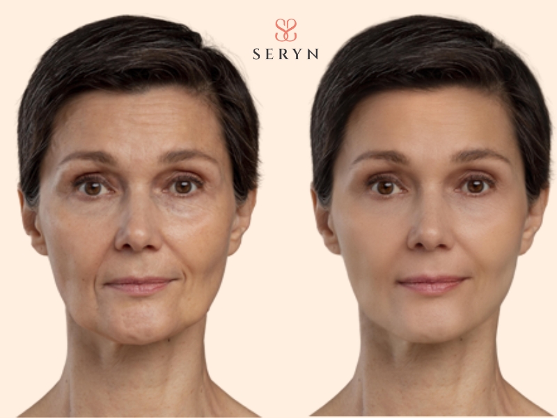 Nâng cơ thon gọn mặt giúp cải thiện chảy xệ và mất đàn hồi sau 35 tuổi