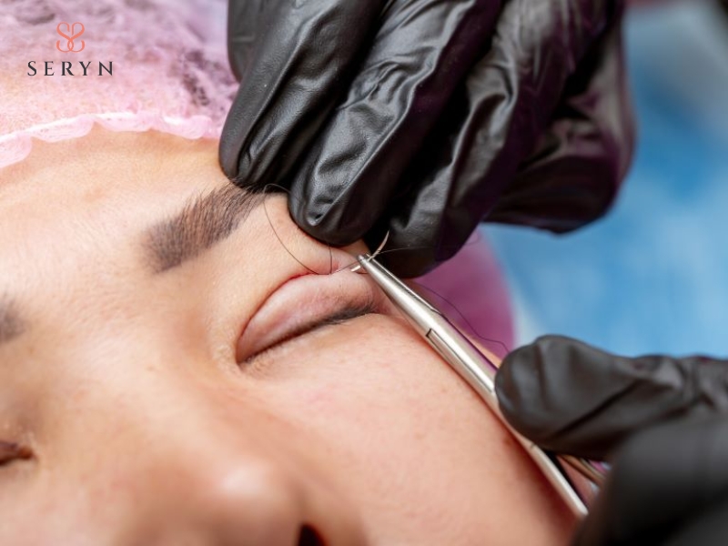 Các va chạm mạnh trực tiếp vào vùng mắt gây sụp đuôi mắt tạm thời 