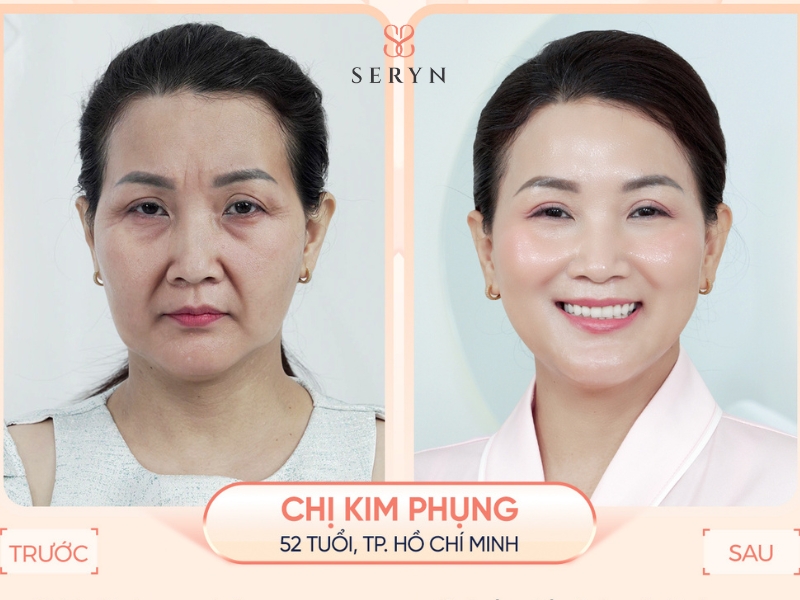 Liệu trình Sera Core nâng cơ vùng mắt giúp cải thiện đuôi mắt xệ tự nhiên không cần nghỉ dưỡng