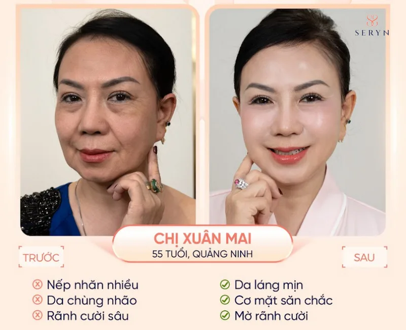 Hiệu quả trước - sau giảm nhăn da rõ rệt bằng SERA CORE 