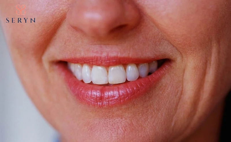 Nếp nhăn dọc quanh môi là biểu hiện rõ nét của quá trình lão hóa mô, tác động nhiều bởi lối sống sinh hoạt