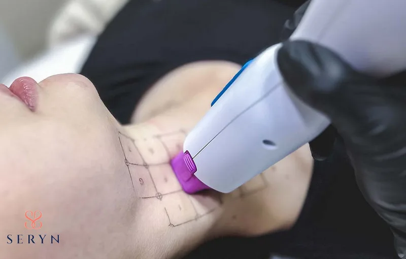 Cách trị nếp nhăn ở cổ bằng Thermage FLX - máy tần số vô tuyến RF 