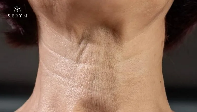 Nếp nhăn ở cổ xuất hiện do yếu tố lão hóa thường thấy 