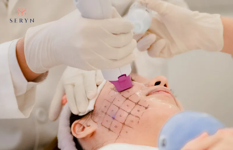 Cải thiện nếp nhăn má bằng Thermage FLX 