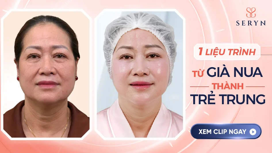 Công nghệ xóa nếp nhăn ở gò má, trẻ hóa toàn mặt SERA CORE 