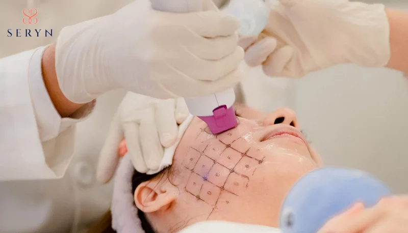 Cách làm hết nếp nhăn ở mũi bằng Thermage FLX