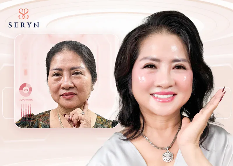 Kết quả trẻ hóa toàn mặt, trong đó có vùng mũi hoàn toàn khác biệt sau khi thực hiện SERA CORE