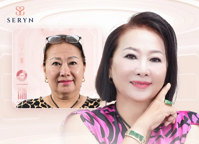 Giải pháp trẻ hóa toàn diện xóa nếp nhăn trán hiệu quả với SERA CORE