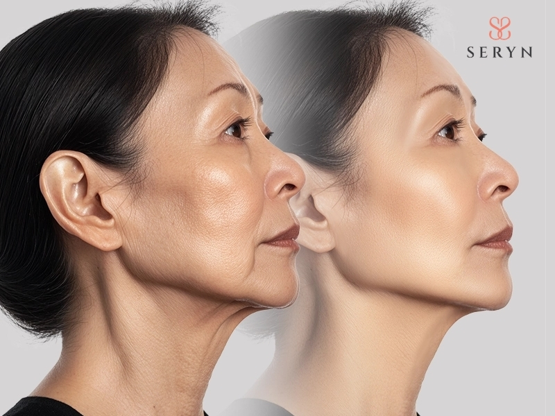 Phẫu thuật căng da mặt truyền thống loại bỏ da dư và mỡ thừa