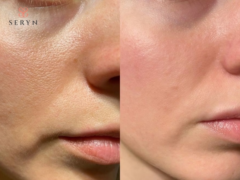 Hiệu quả của phẫu thuật nâng cơ mặt thường duy trì được nhiều năm