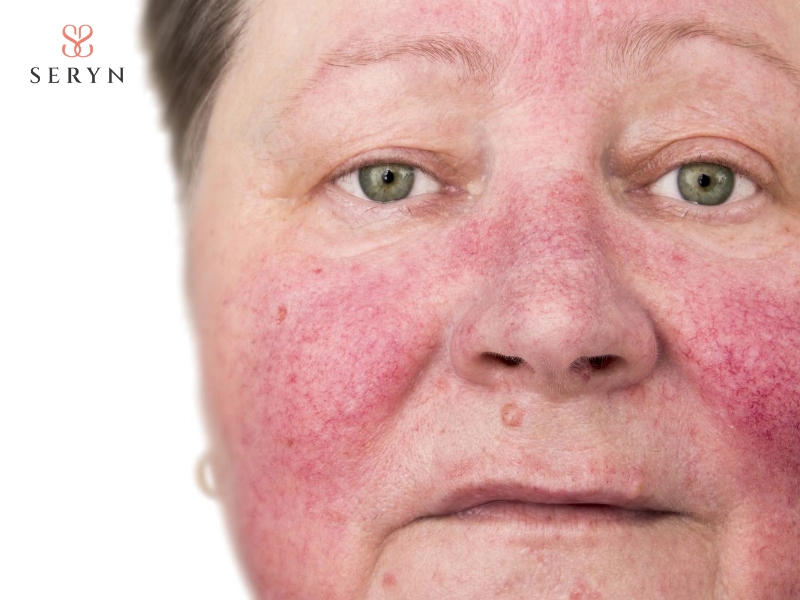 Bỏng da và phồng rộp là biến chứng nguy hiểm sau khi nâng cơ hifu Bỏng da và phồng rộp là biến chứng nguy hiểm sau khi nâng cơ hifu