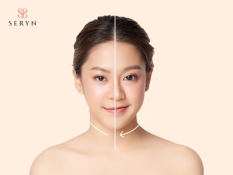 Gương mặt mất cân đối, lệch nhẹ sau điều trị nâng cơ Gương mặt mất cân đối, lệch nhẹ sau điều trị nâng cơ