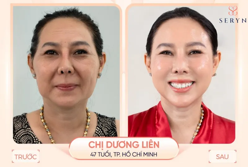 Sự khác biệt rõ rệt sau khi trẻ hóa, xóa nhăn toàn diện bằng SERA CORE 