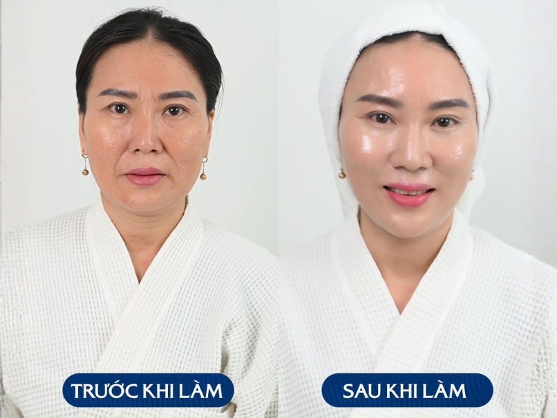 Ultherapy an toàn, không xâm lấn và cho hiệu quả lâu dài Ultherapy an toàn, không xâm lấn và cho hiệu quả lâu dài