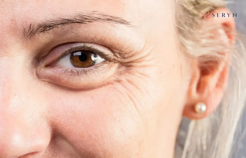 Nếp nhăn mắt - mức độ nào bạn đang gặp phải?