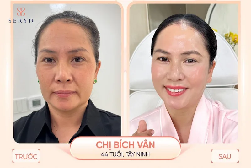 Hiệu quả xóa nhăn vùng trán và trẻ hóa toàn mặt của chị khách sau khi thực hiện SERA CORE