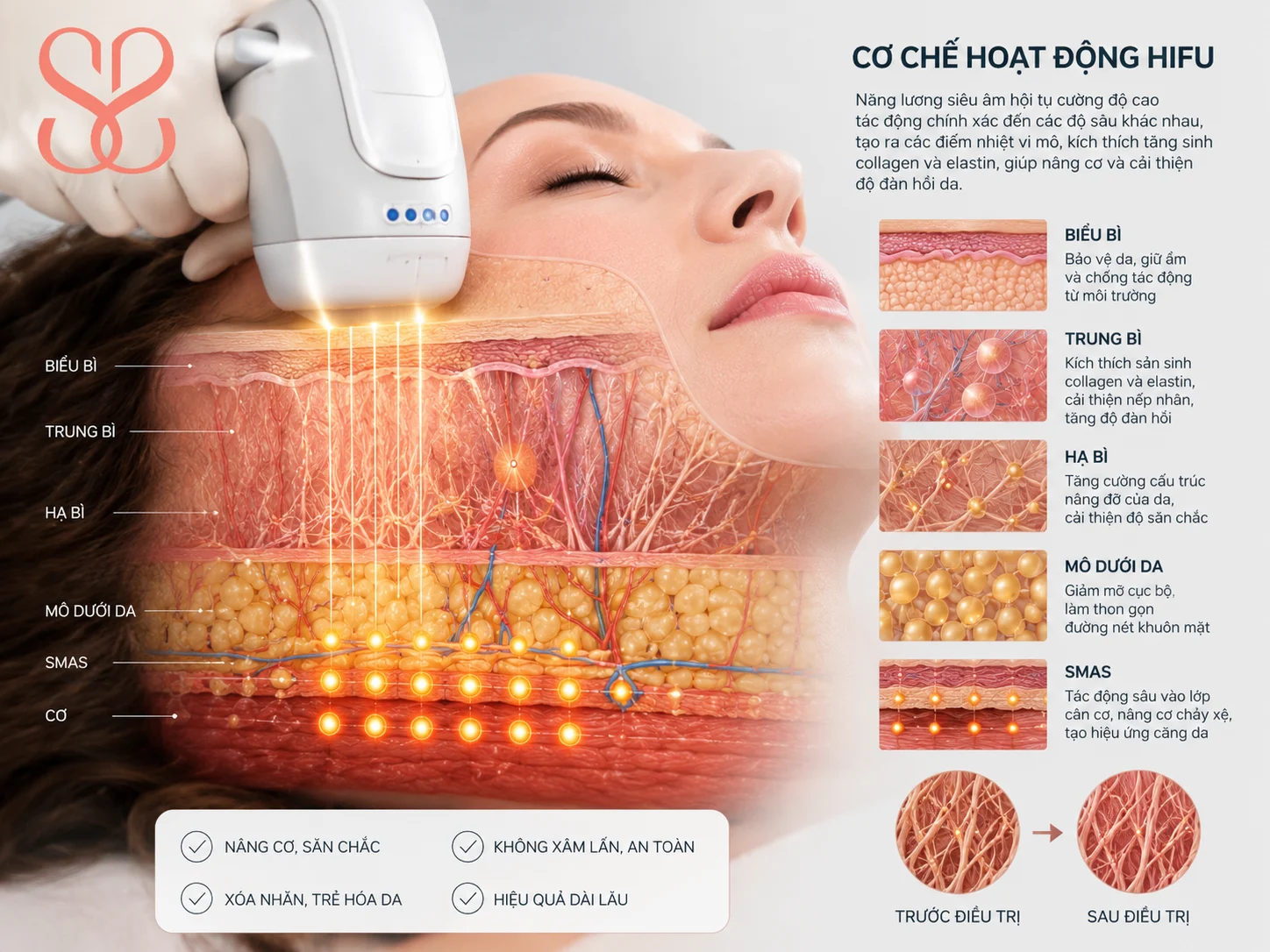Cơ chế sóng siêu âm hội tụ cường độ cao tác động vào hạ bì và trung bì