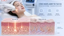 Công nghệ laser trẻ hoá da là gì và hoạt động như thế nào?