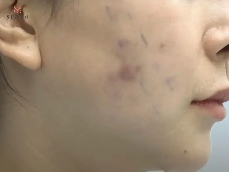 Căng chỉ collagen có thể gây sưng, bầm cần được theo dõi Căng chỉ collagen có thể gây sưng, bầm cần được theo dõi