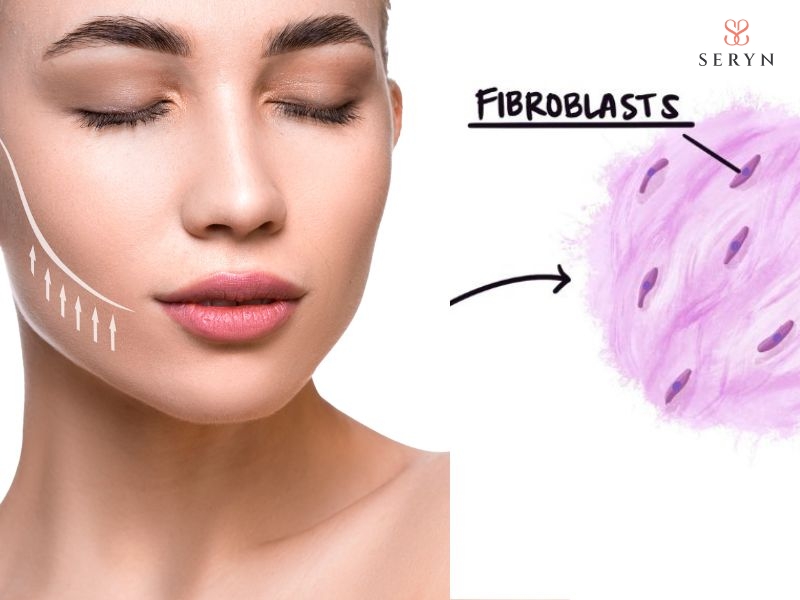 Nguyên bào sợi tổng hợp collagen mới dọc theo đường đi của sợi chỉ trong mô da Nguyên bào sợi tổng hợp collagen mới dọc theo đường đi của sợi chỉ trong mô da