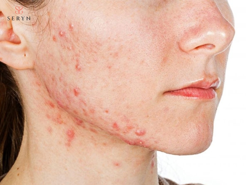 Người có mụn viêm tại vùng cằm không phù hợp căng chỉ collagen Người có mụn viêm tại vùng cằm không phù hợp căng chỉ collagen