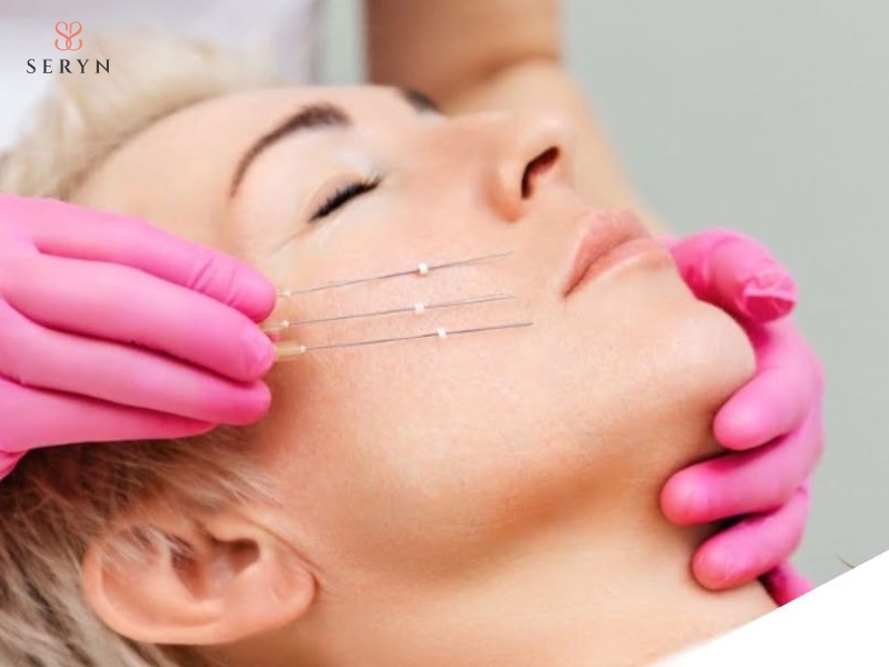 Căng chỉ vùng rãnh cười và khóe miệng tập trung cải thiện nếp gấp và mô chùng Căng chỉ vùng rãnh cười và khóe miệng tập trung cải thiện nếp gấp và mô chùng