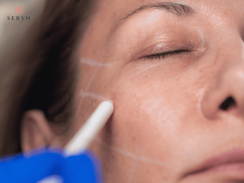 Quy trình thực hiện chuẩn căng chỉ collagen cho vùng mặt Quy trình thực hiện chuẩn căng chỉ collagen cho vùng mặt