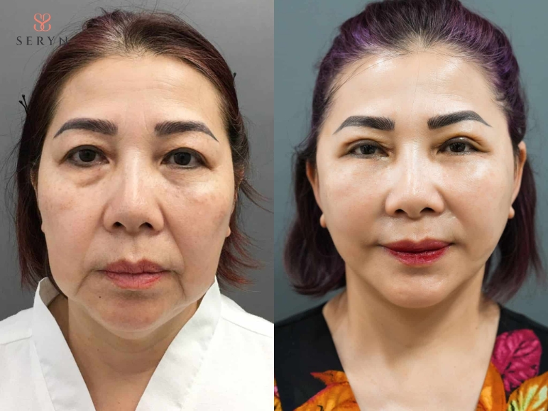 Hiệu quả nâng cơ xuất hiện sớm và thay đổi dần theo quá trình tái tạo collagen Hiệu quả nâng cơ xuất hiện sớm và thay đổi dần theo quá trình tái tạo collagen