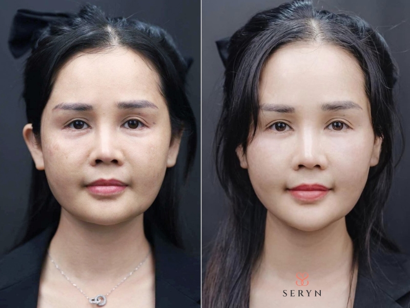 Thời gian duy trì hiệu quả của căng chỉ và Facelift thường duy trì được 7-10 năm Thời gian duy trì hiệu quả của căng chỉ và Facelift thường duy trì được 7-10 năm